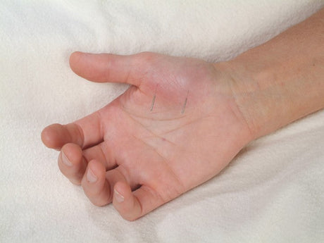 Needling Master Tung’s Double Child, Double Fairy