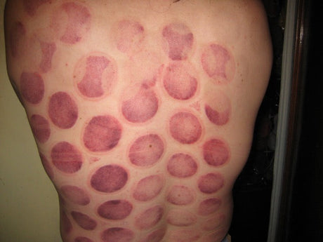The Ancient Art of Cupping