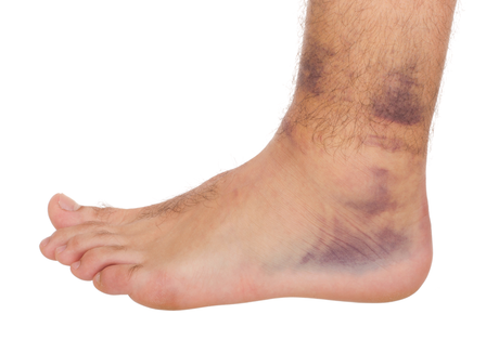 Blood Stasis in Traditional Chinese Medicine