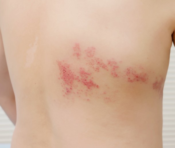 TCM for Shingles / Herpes Zoster Virus – Mayway Herbs