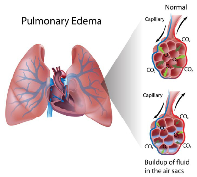 Dampness in Lungs