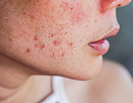 Chinese Medicine and Acne