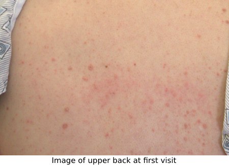 Chinese medicine treatment of lichen planus - before photos of patient's rash on upper back
