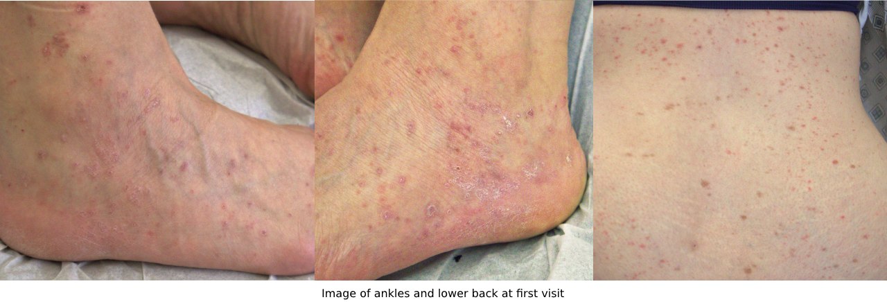 Chinese medicine treatment of lichen planus - before photos of patient's rash