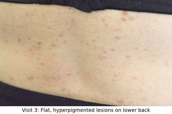 Chinese medicine treatment of lichen planus - visit 3 photo of lower back improvement of rash