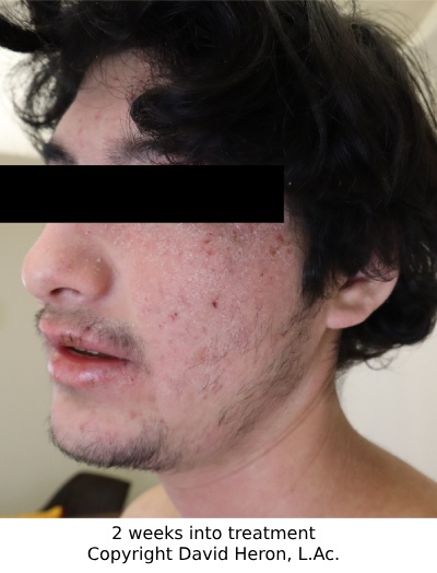 Case study photo showing patient's face after 2 weeks of taking chinese herbs showing strong improvement copyright