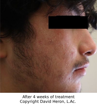 Case study photo showing patient's face after 4 weeks of taking chinese herbs showing almost clear face copyright