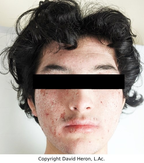 Case study photo showing patient's face rash at first visit copyright