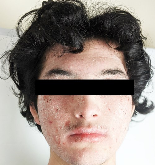 Case study photo showing patient's face rash at first visit