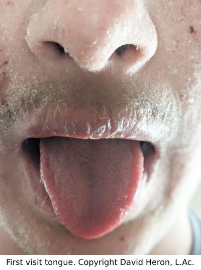 Case study photo showing patient's tongue at first visit with strong red sections copyright