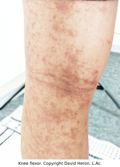Case study photo showing patient's knee rash with hypopigmentation copyright