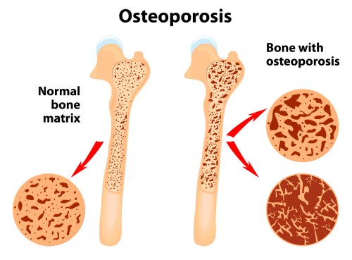 graphic of 2 bones - one with small holes and one with larger holes indicating osteoporosis