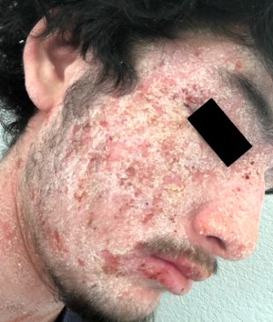 Case study photo showing patient's face before first visit showing severe eczema on the face