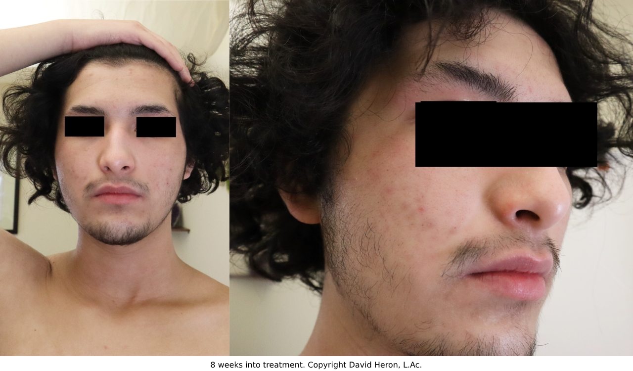 Case study photo showing patient photos after 8 weeks with chinese herbalist treatment showing almost complete resolution of face rash copyright
