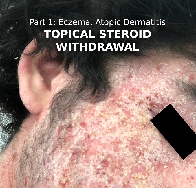 Photo of a severe case of eczema on the face with text for article that says part 1 eczema atopic dermatitis topical steroid withdrawal click for article