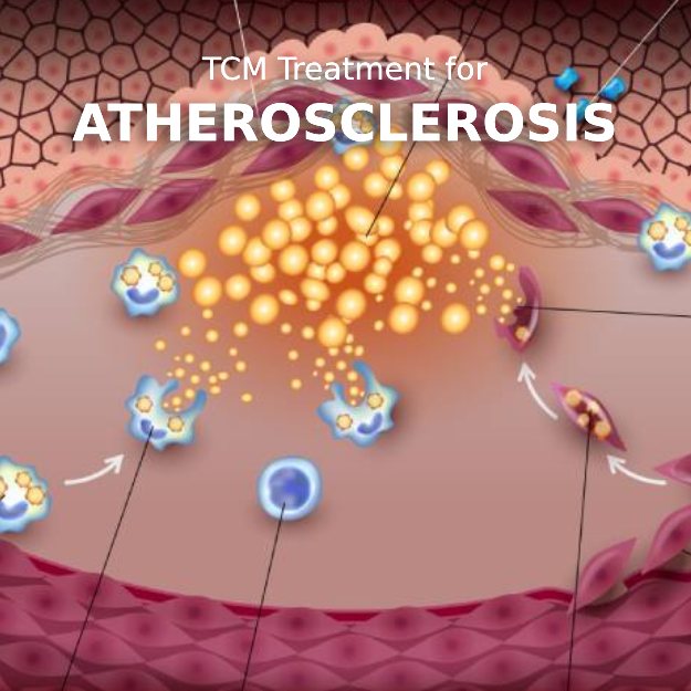 graphic showing an artery with text tcm treatment for atherosclerosis