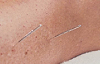 Image of 2 acupuncture needles in a leg showing the pattern Beside Three Miles