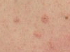 Image of a rash on a back